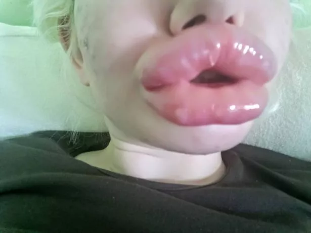 angle green reccomend Huge Fake Lips Tumblr