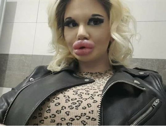 dan rullan reccomend huge fake lips tumblr pic